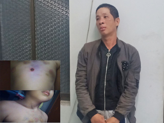 Bé Su thương tích 51%: Rùng mình những lần bị 'ba Việt' chích thuốc lá vào háng, vùng kín